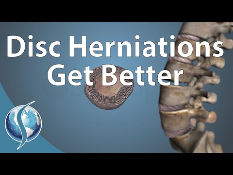 Can a Disc Herniation Heal Itself?