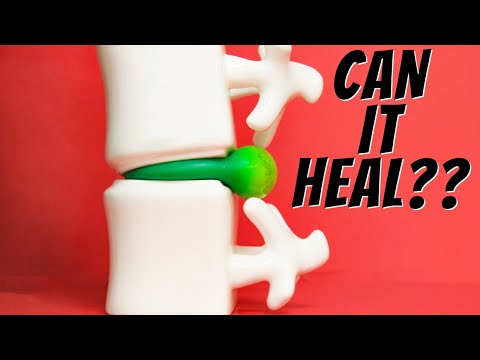Can My Herniated , Bulging Disc or Sciatica Heal, How Long