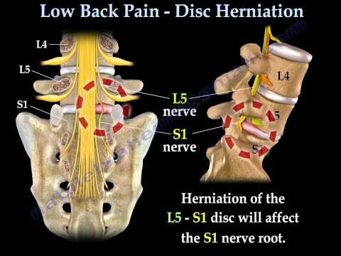 Low Back Pain –   Disc  Herniation ,Sciatica  – Everything You Need To Know – Dr. Nabil Ebraheim