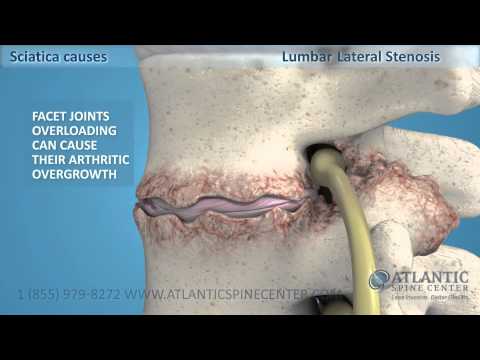 Sciatica Overview